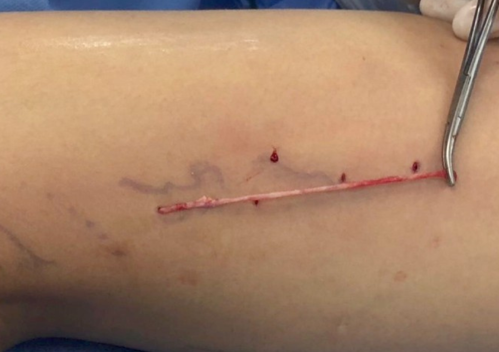 Cirurgia Vascular